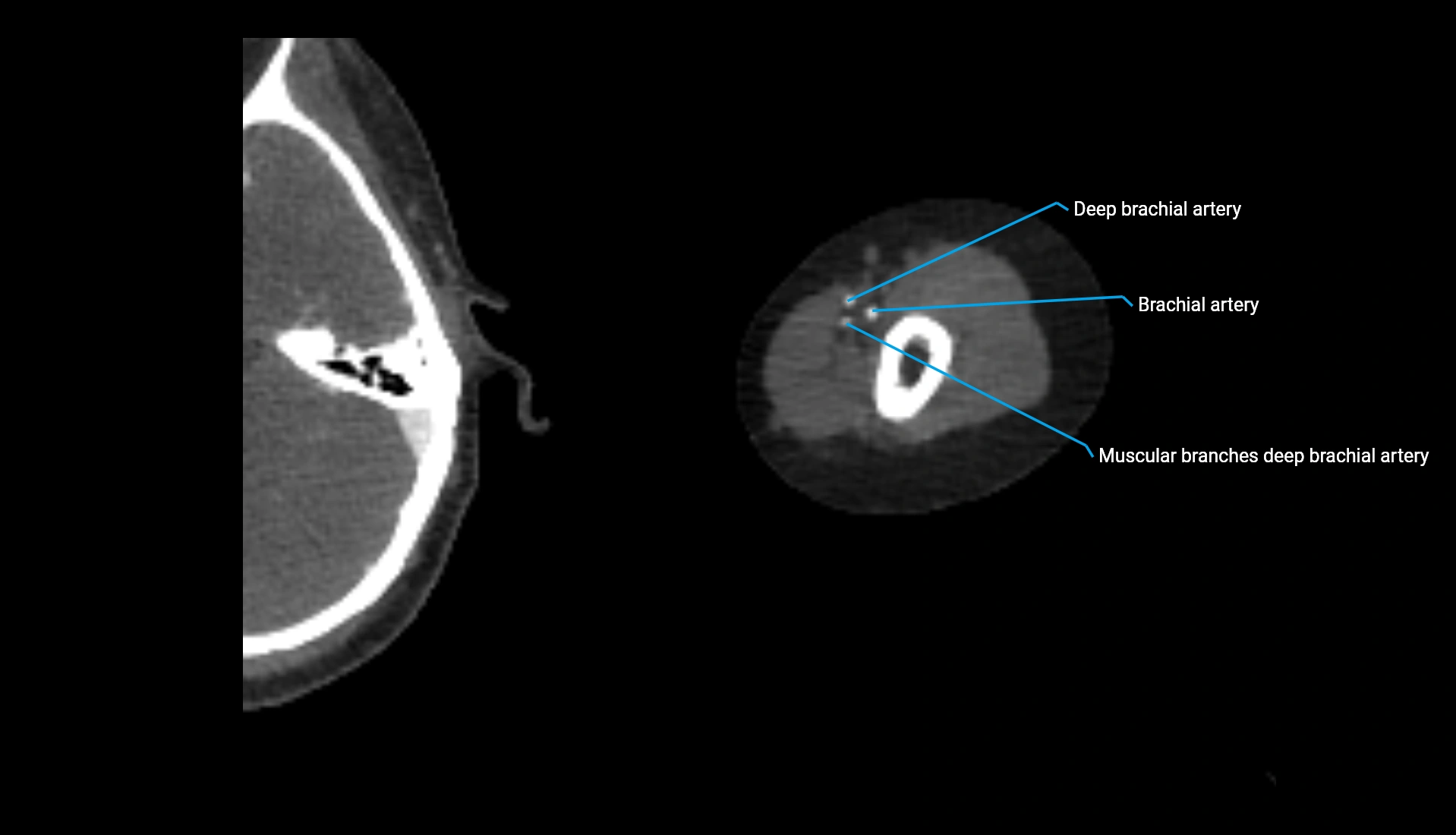 CTA upper limb axial cross sectional anatomy labelled image 257 (2).webp